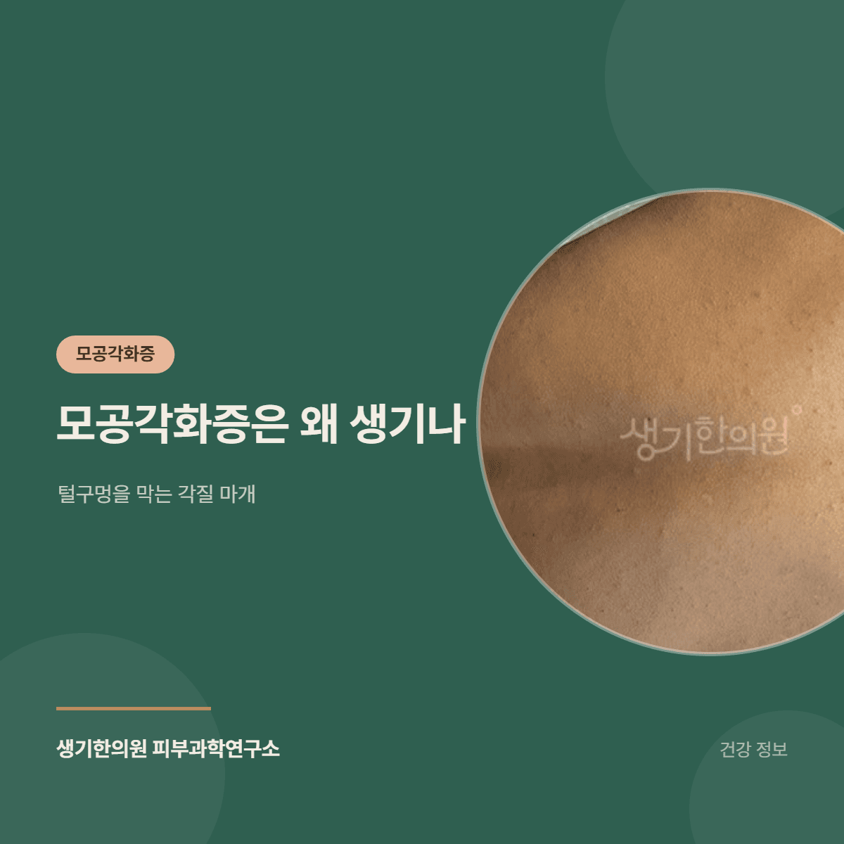 모공각화증은 왜 생기나 — 털구멍을 막는 각질 마개 대표 이미지