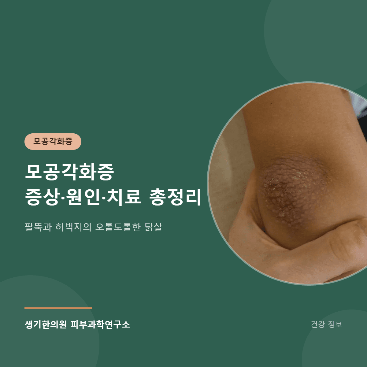 모공각화증 증상·원인·치료 총정리 대표 이미지