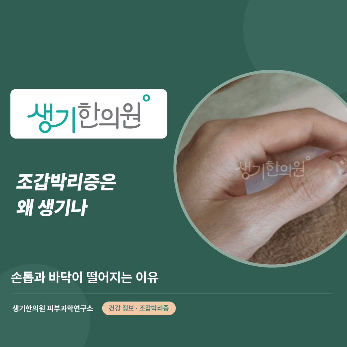 조갑박리증은 왜 생기나 — 손톱과 바닥이 떨어지는 이유 대표 이미지