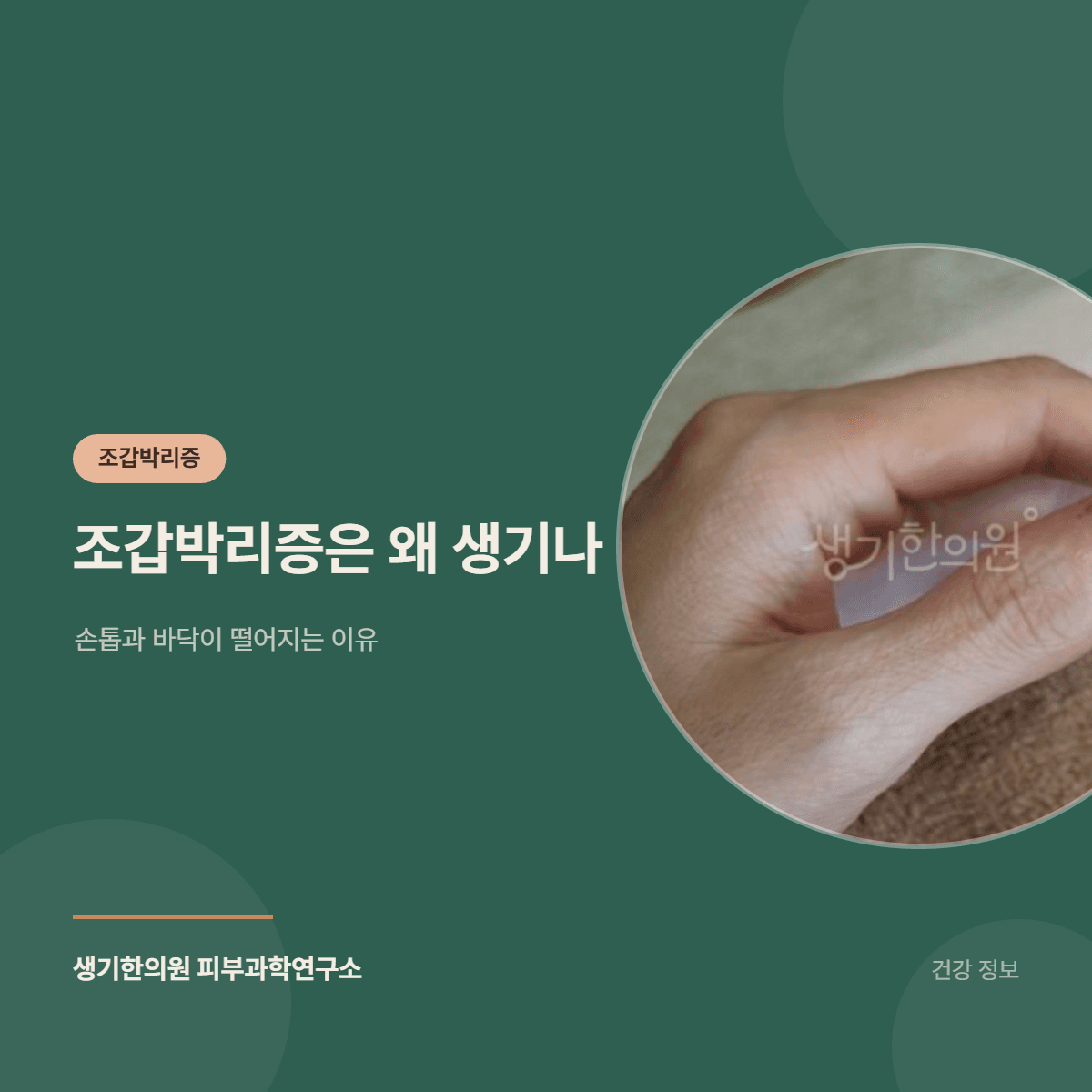 조갑박리증은 왜 생기나 — 손톱과 바닥이 떨어지는 이유 대표 이미지