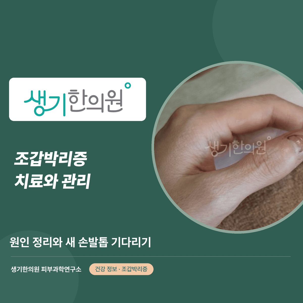 조갑박리증 치료와 관리 — 원인 정리와 새 손발톱 기다리기 대표 이미지