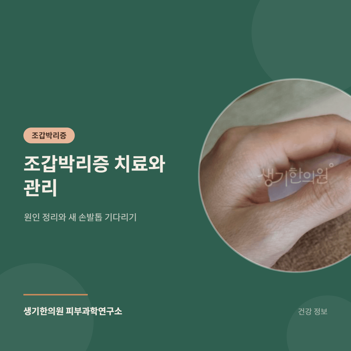 조갑박리증 치료와 관리 — 원인 정리와 새 손발톱 기다리기 대표 이미지