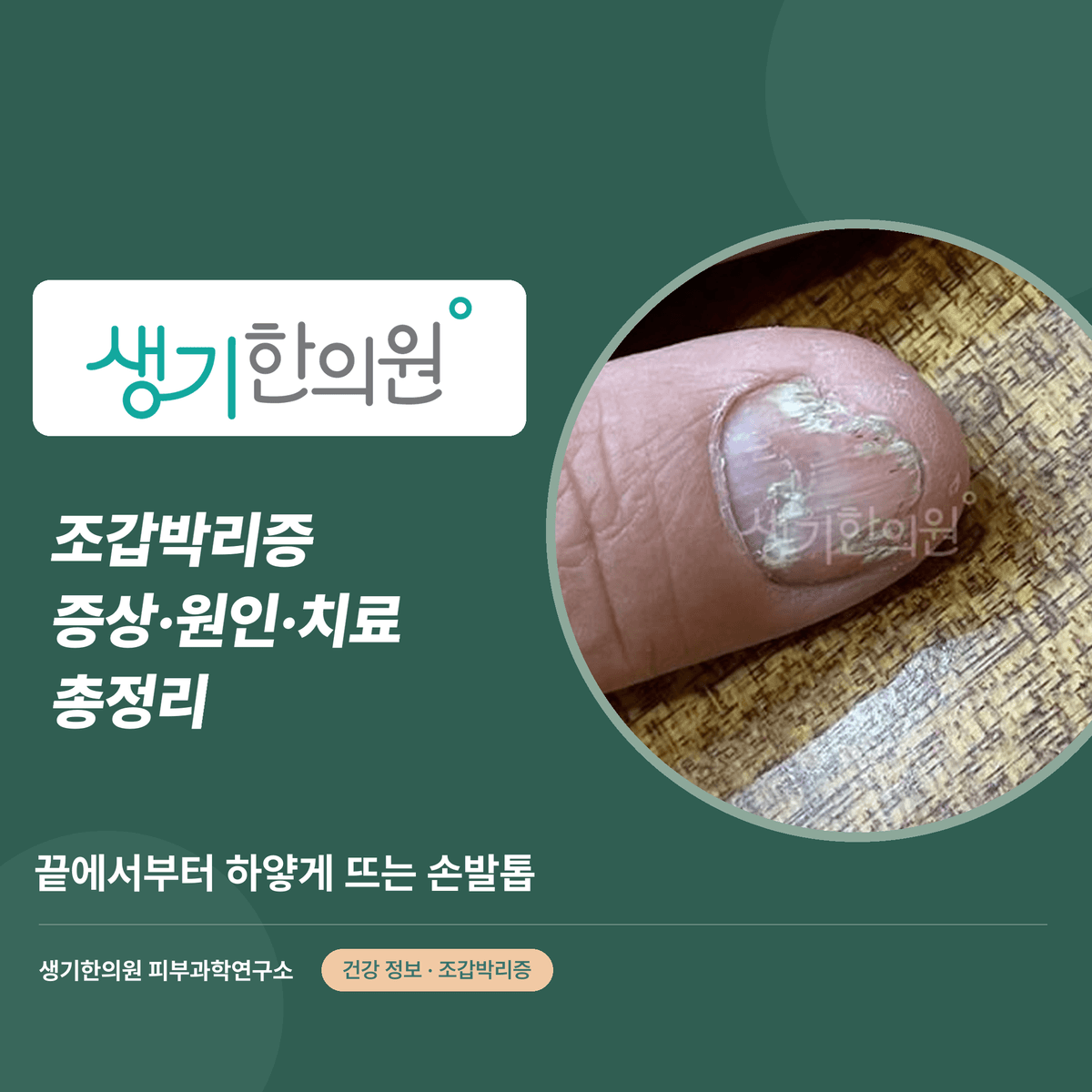 조갑박리증 증상·원인·치료 총정리 대표 이미지