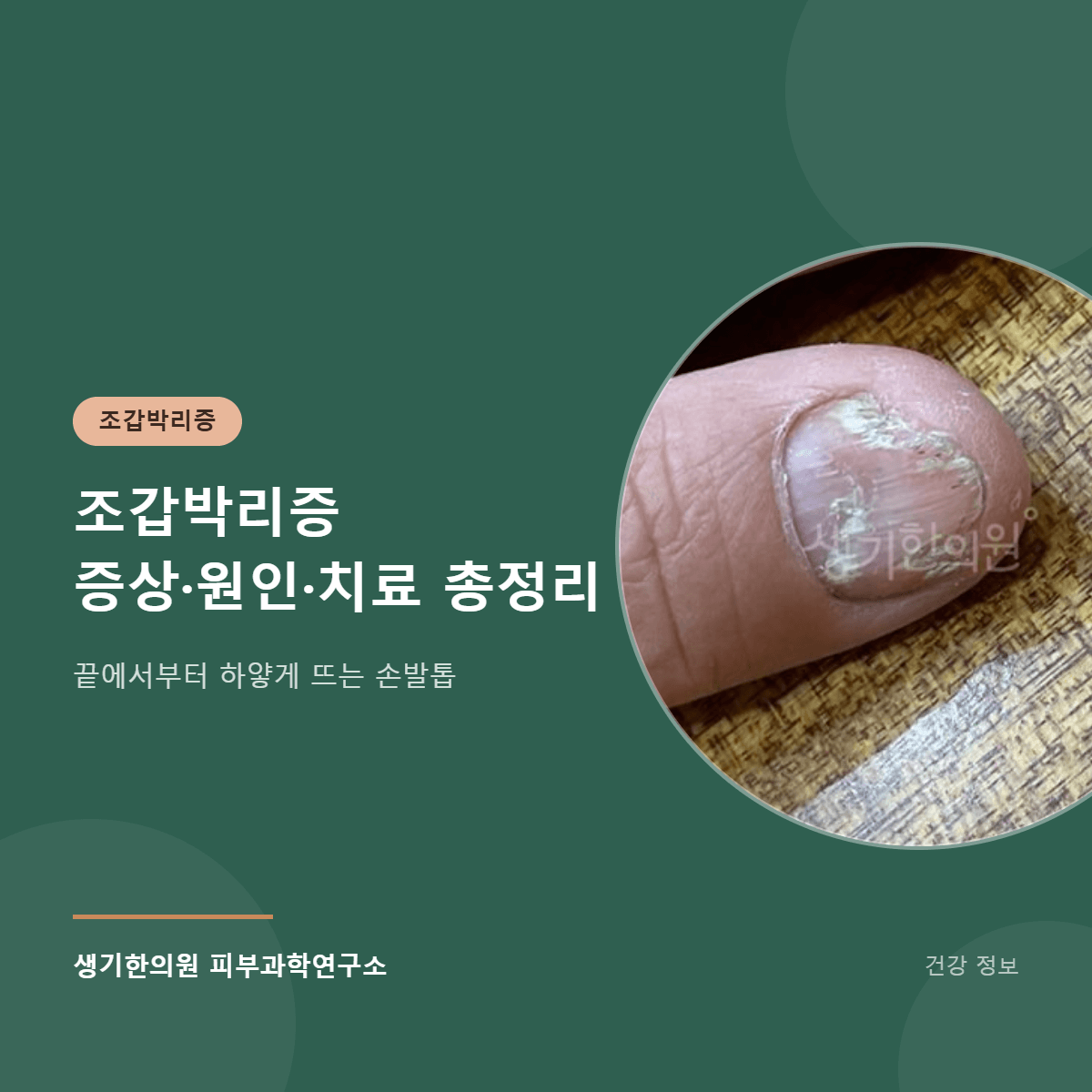 조갑박리증 증상·원인·치료 총정리 대표 이미지