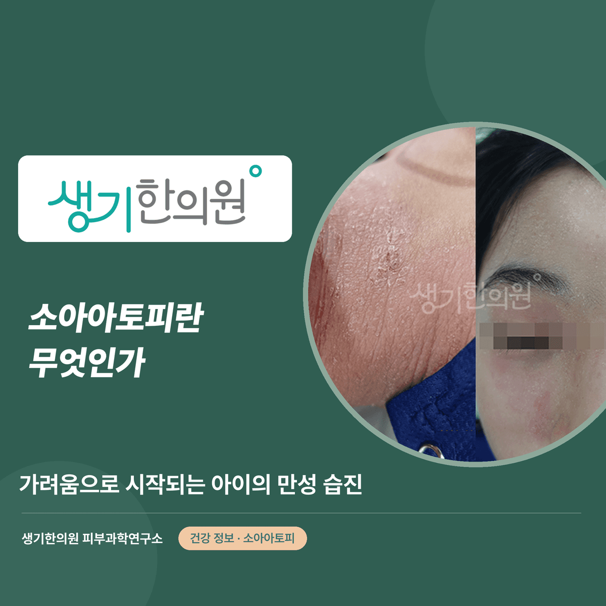 소아아토피란 무엇인가 — 가려움으로 시작되는 아이의 만성 습진 대표 이미지