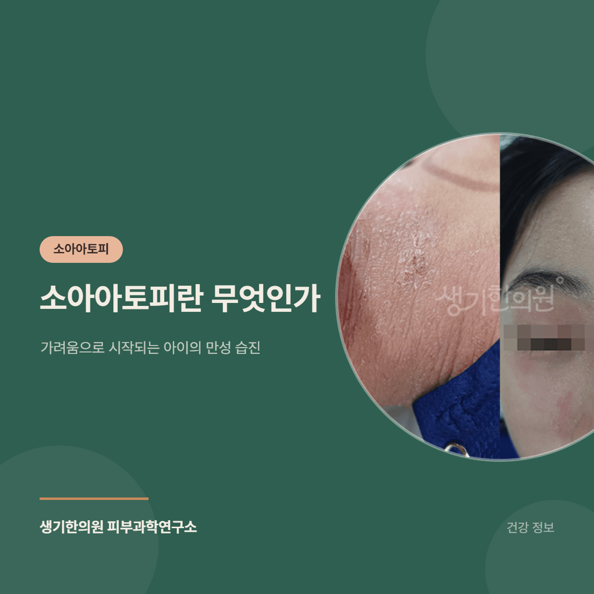 소아아토피란 무엇인가 — 가려움으로 시작되는 아이의 만성 습진 대표 이미지