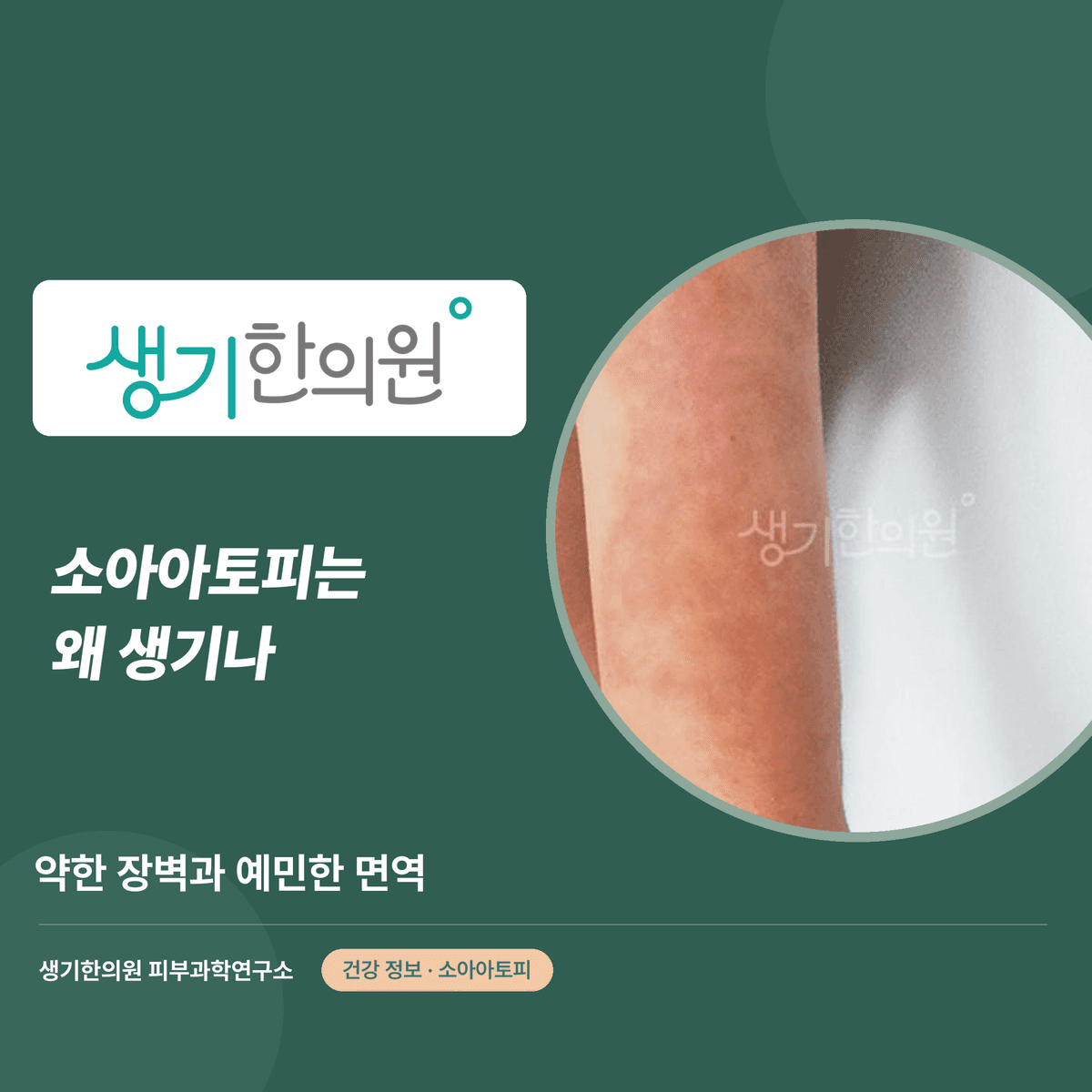 소아아토피는 왜 생기나 — 약한 장벽과 예민한 면역 대표 이미지