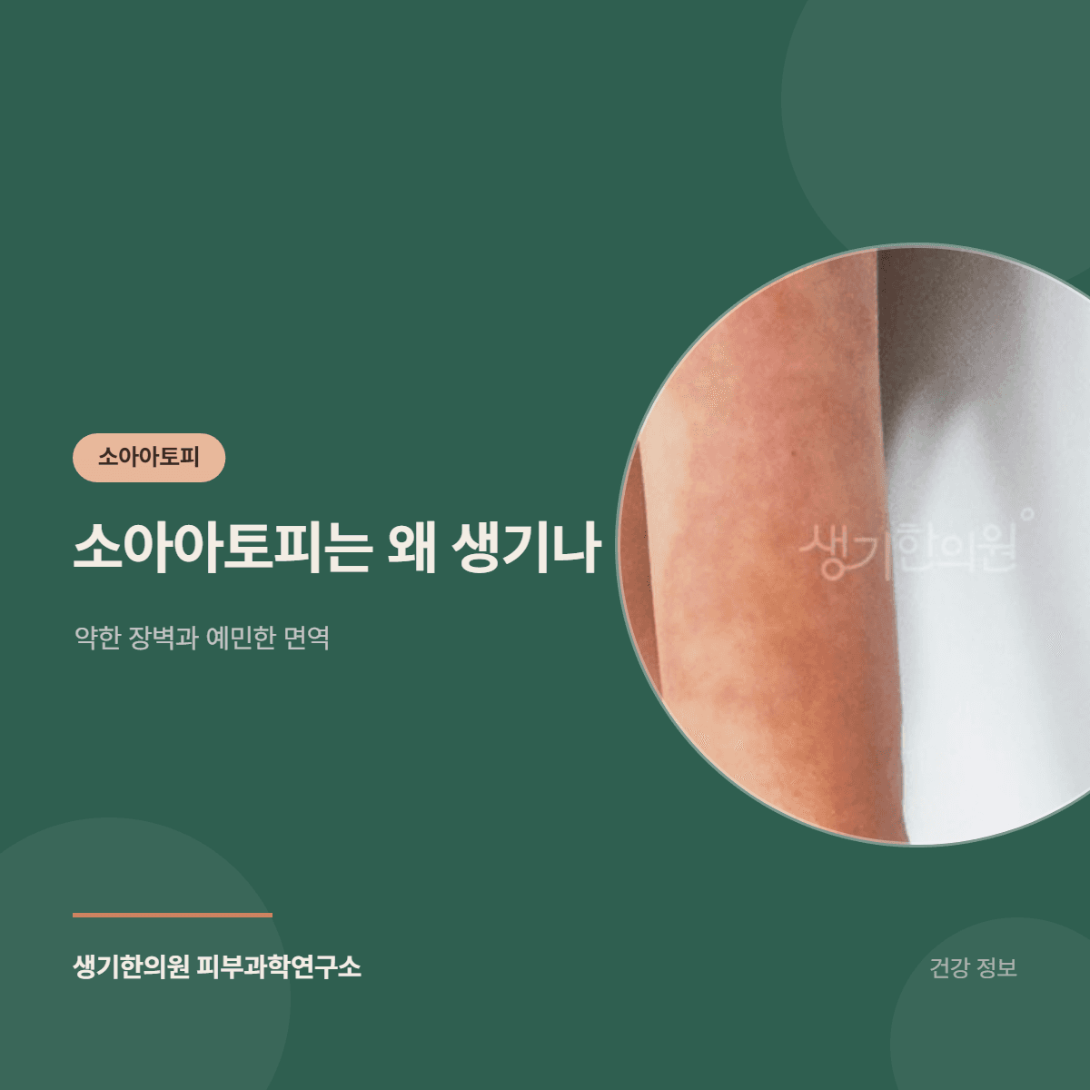 소아아토피는 왜 생기나 — 약한 장벽과 예민한 면역 대표 이미지