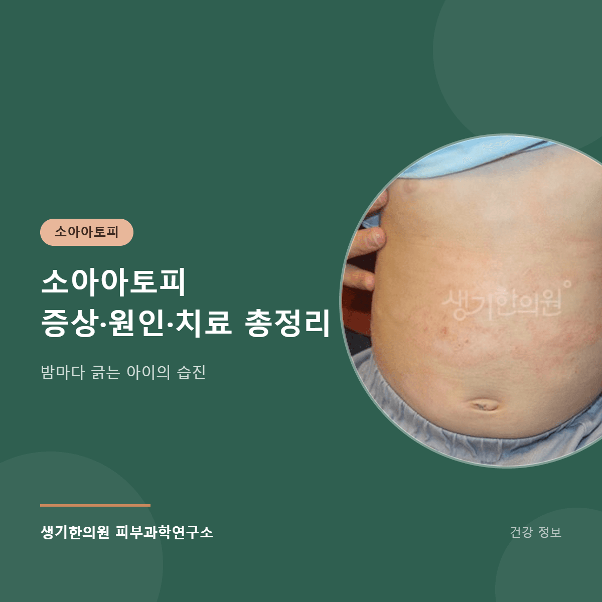 소아아토피 증상·원인·치료 총정리 대표 이미지