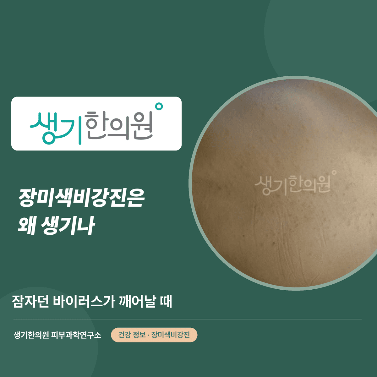 장미색비강진은 왜 생기나 — 잠자던 바이러스가 깨어날 때 대표 이미지