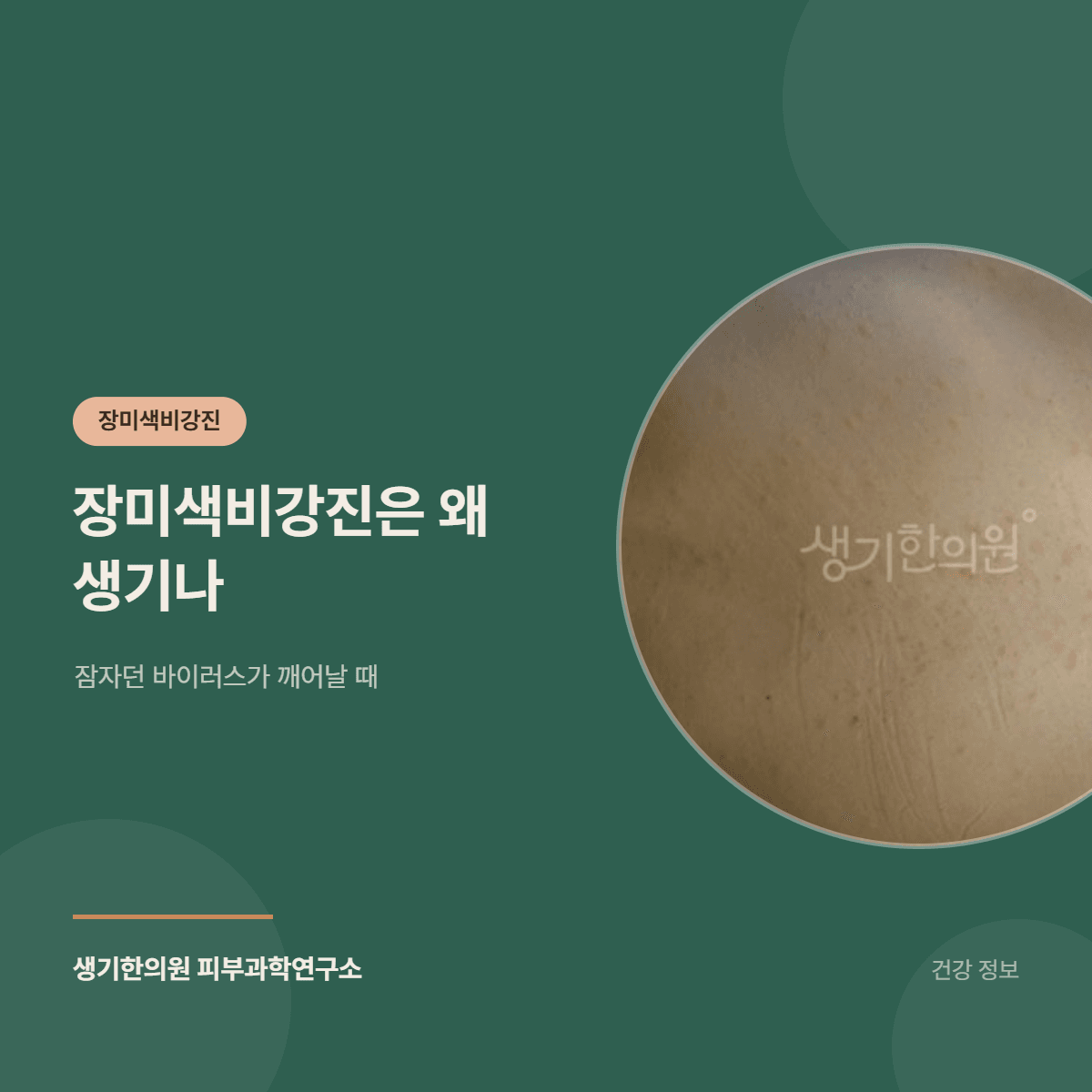 장미색비강진은 왜 생기나 — 잠자던 바이러스가 깨어날 때 대표 이미지