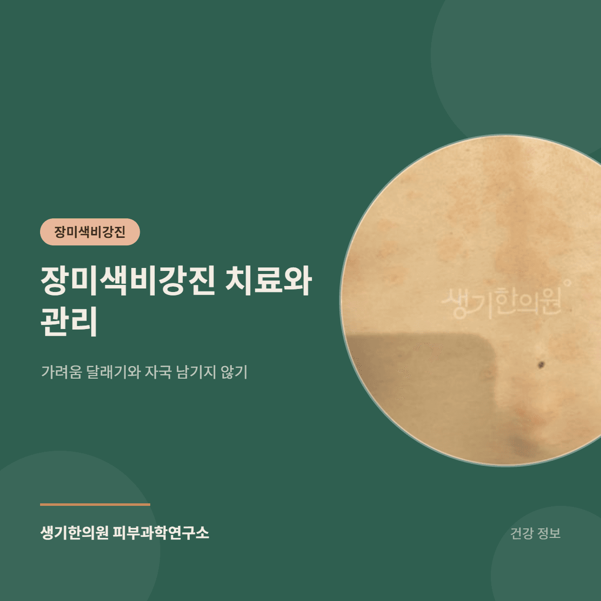 장미색비강진 치료와 관리 — 가려움 달래기와 자국 남기지 않기 대표 이미지
