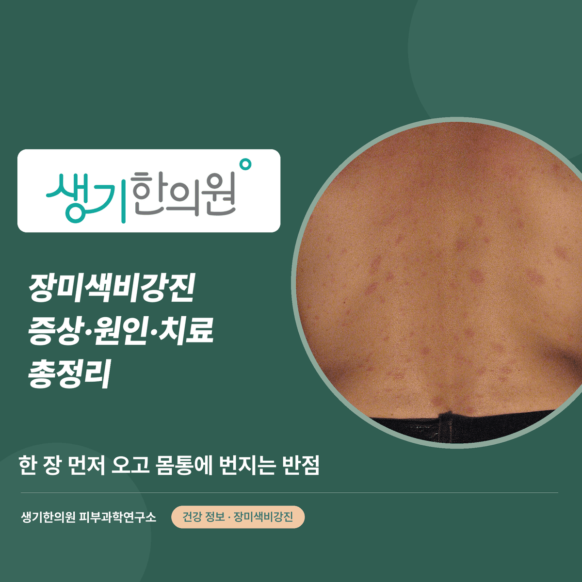 장미색비강진 증상·원인·치료 총정리 대표 이미지