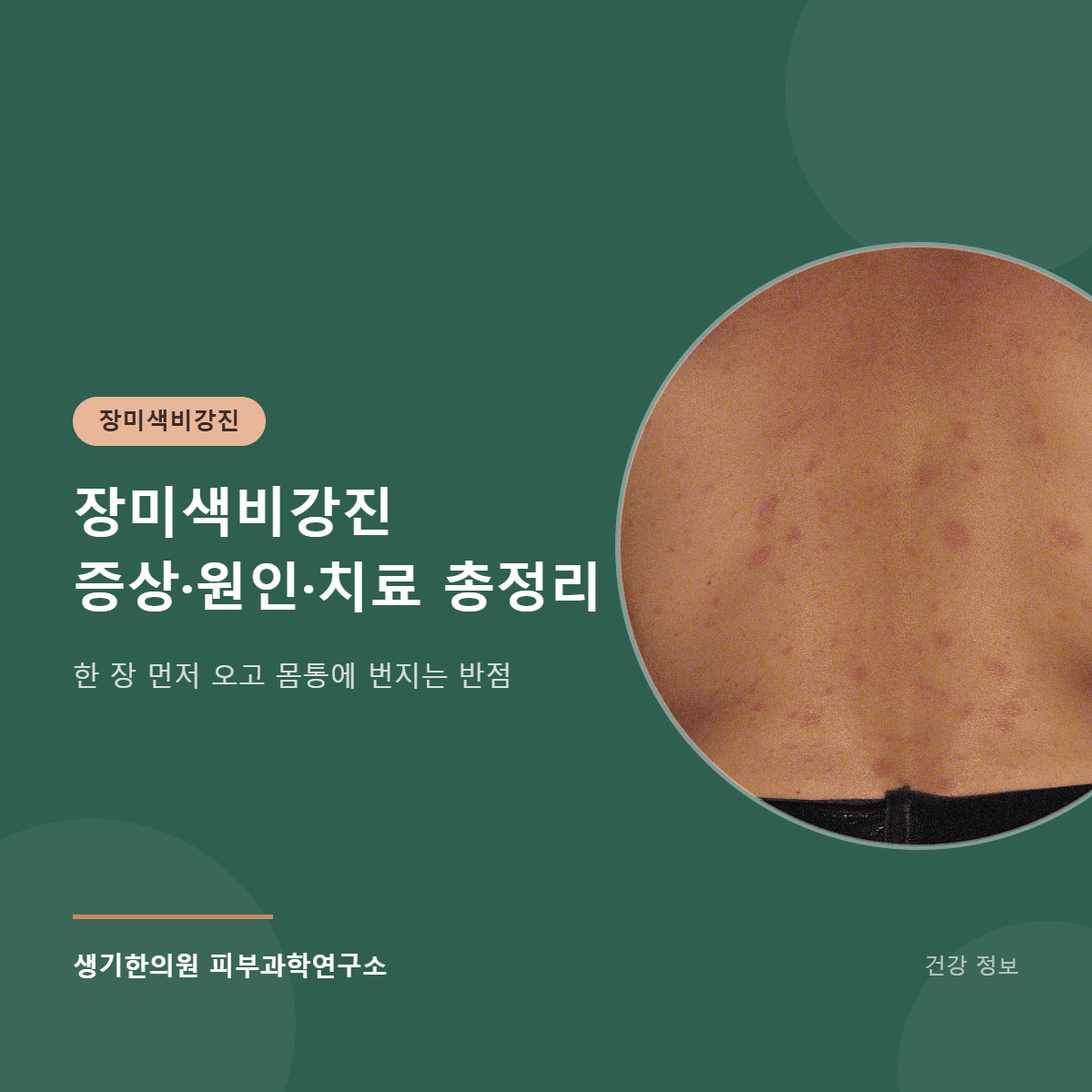 장미색비강진 증상·원인·치료 총정리 대표 이미지