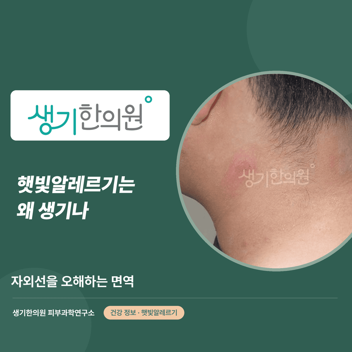 햇빛알레르기는 왜 생기나 — 자외선을 오해하는 면역 대표 이미지