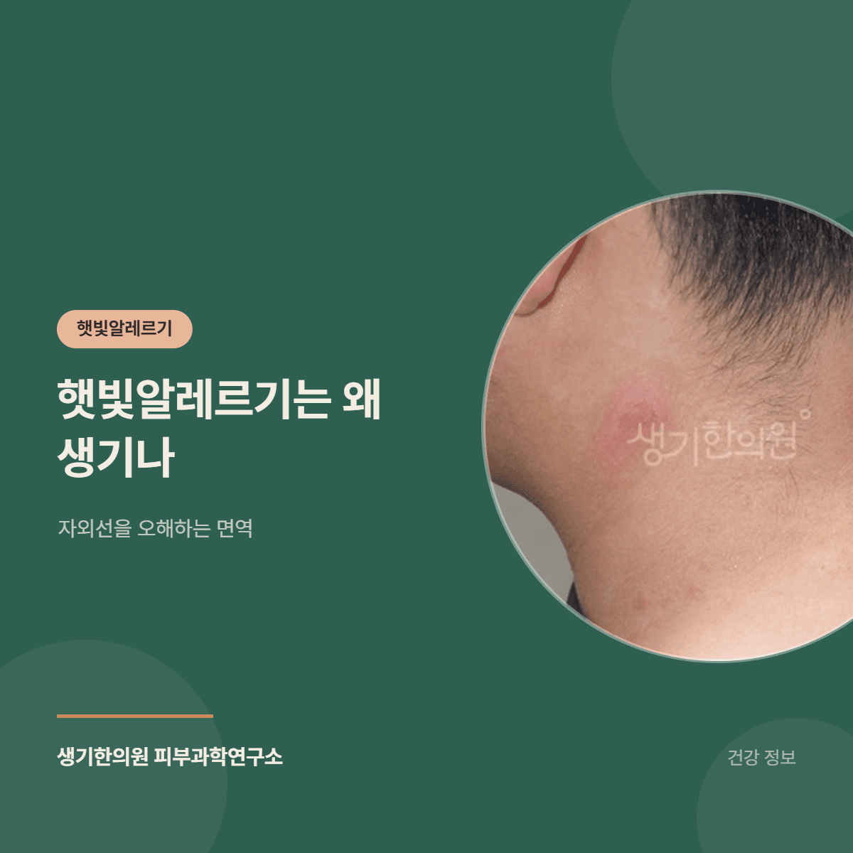 햇빛알레르기는 왜 생기나 — 자외선을 오해하는 면역 대표 이미지