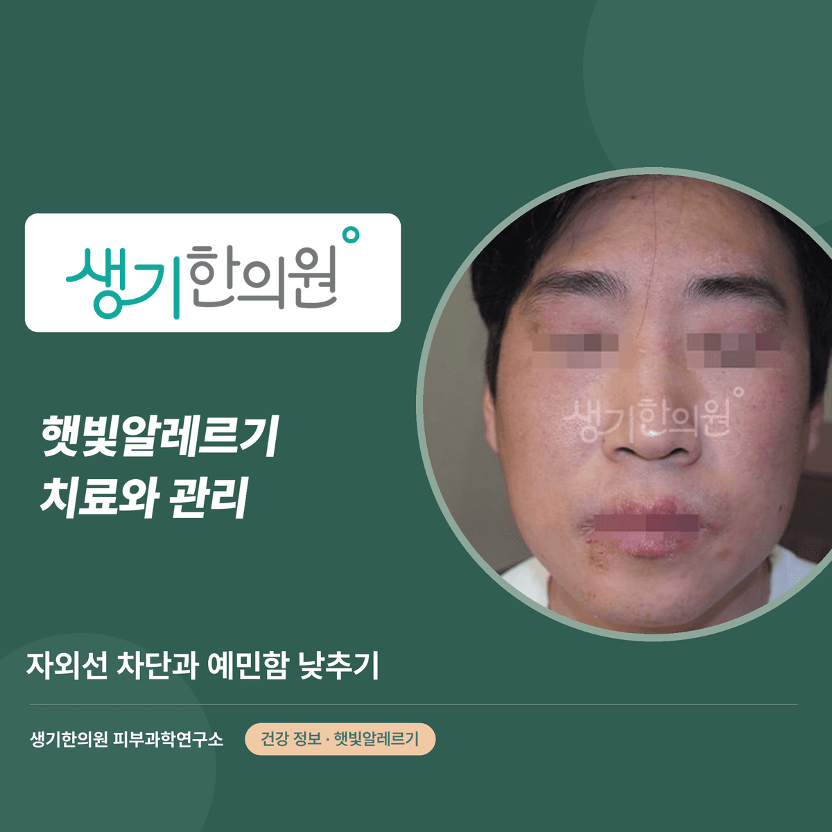 햇빛알레르기 치료와 관리 — 자외선 차단과 예민함 낮추기 대표 이미지