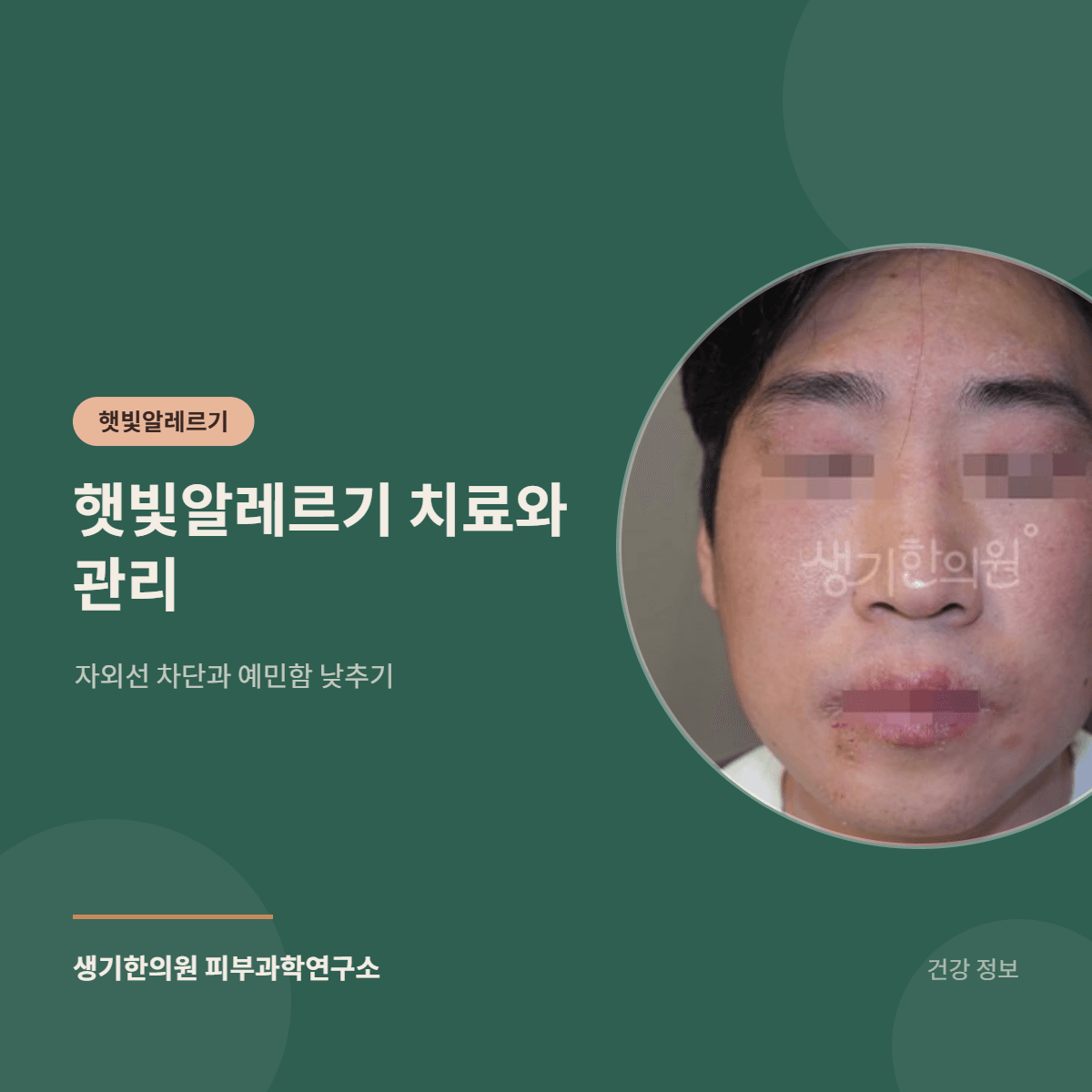 햇빛알레르기 치료와 관리 — 자외선 차단과 예민함 낮추기 대표 이미지