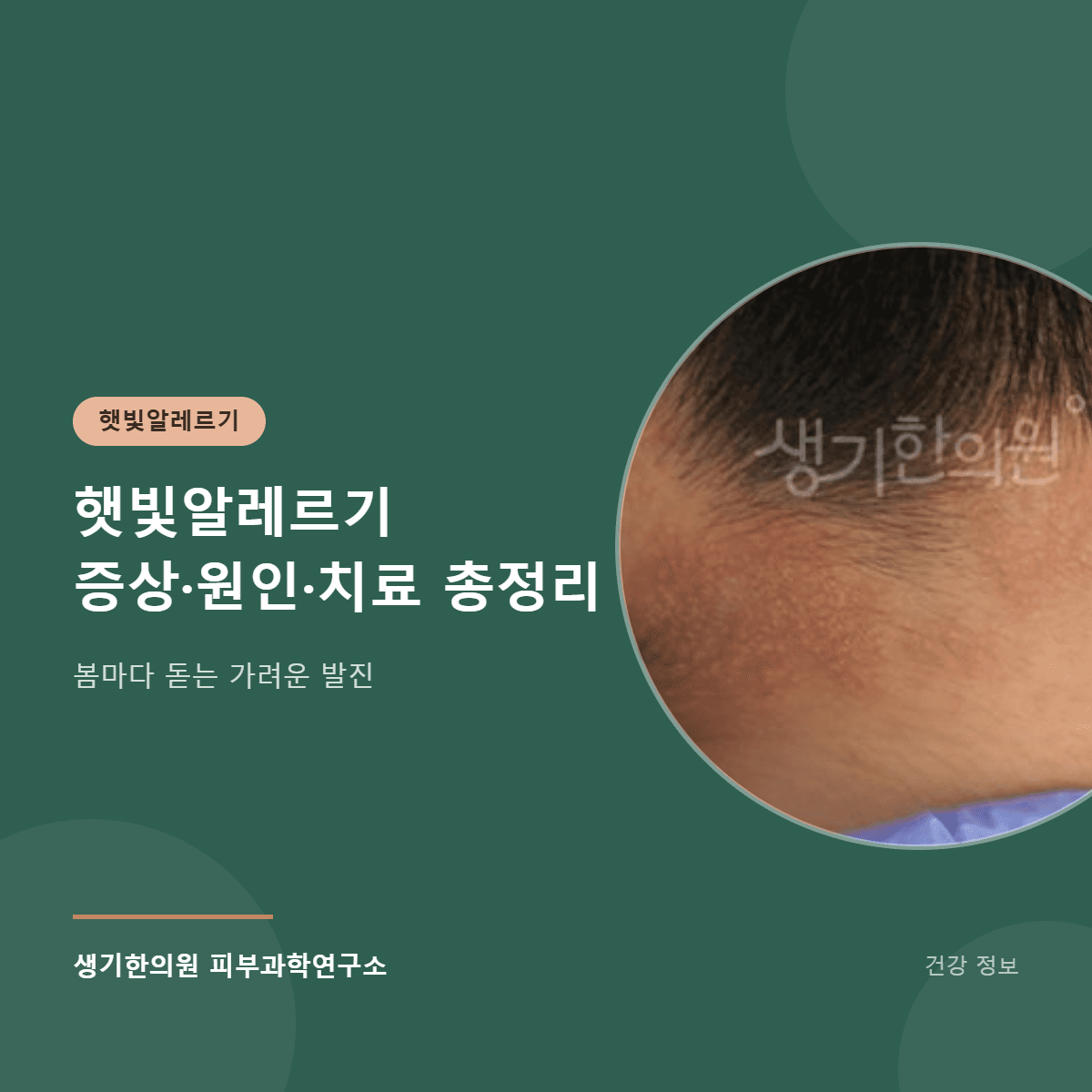 햇빛알레르기 증상·원인·치료 총정리 대표 이미지