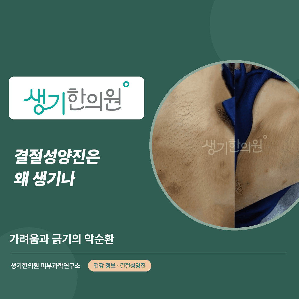 결절성양진은 왜 생기나 — 가려움과 긁기의 악순환 대표 이미지