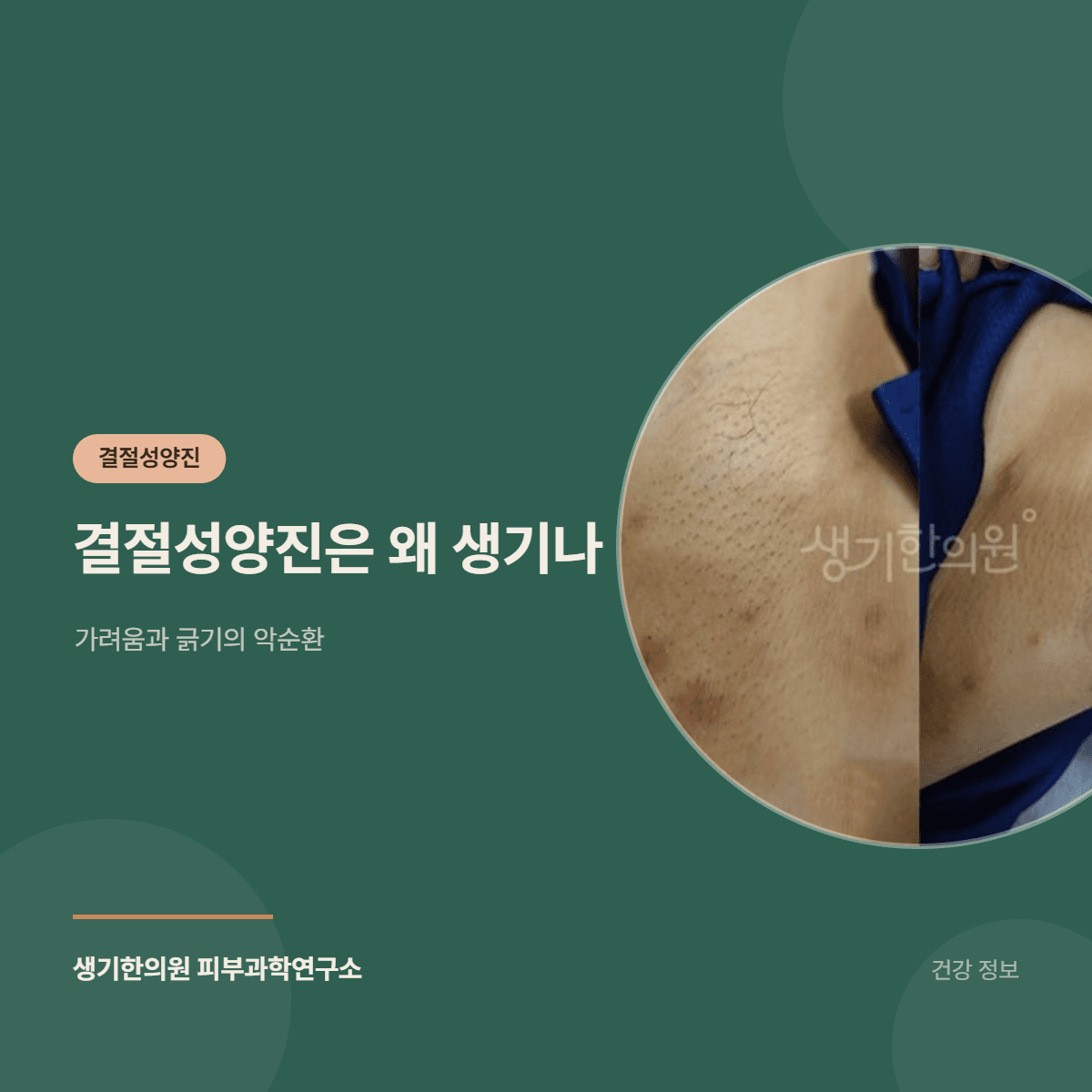 결절성양진은 왜 생기나 — 가려움과 긁기의 악순환 대표 이미지