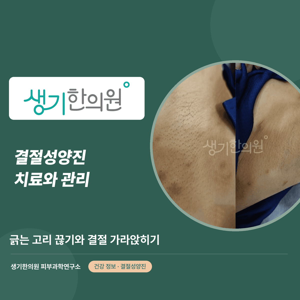 결절성양진 치료와 관리 — 긁는 고리 끊기와 결절 가라앉히기 대표 이미지