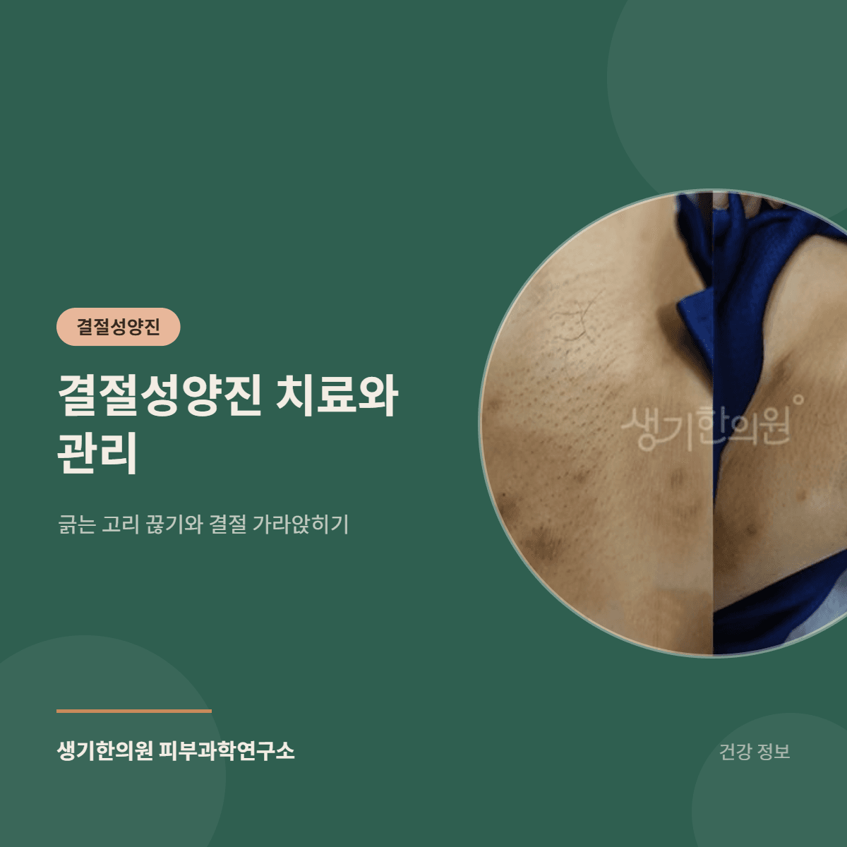 결절성양진 치료와 관리 — 긁는 고리 끊기와 결절 가라앉히기 대표 이미지