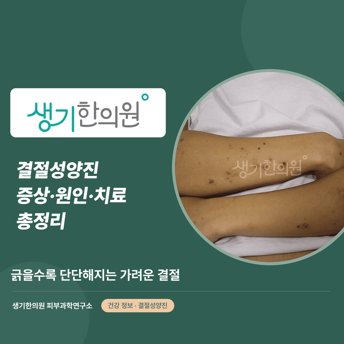결절성양진 증상·원인·치료 총정리 대표 이미지