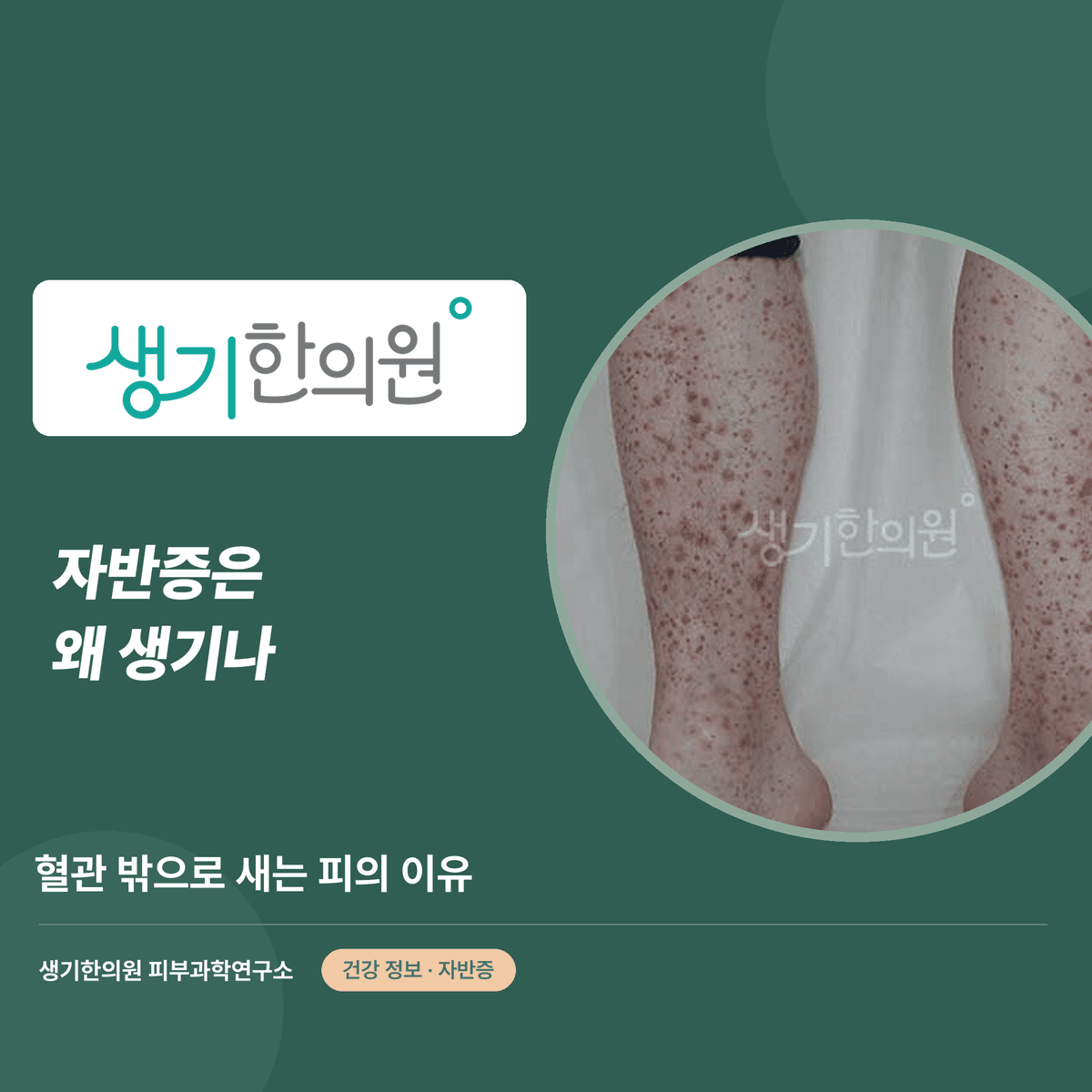 자반증은 왜 생기나 — 혈관 밖으로 새는 피의 이유 대표 이미지