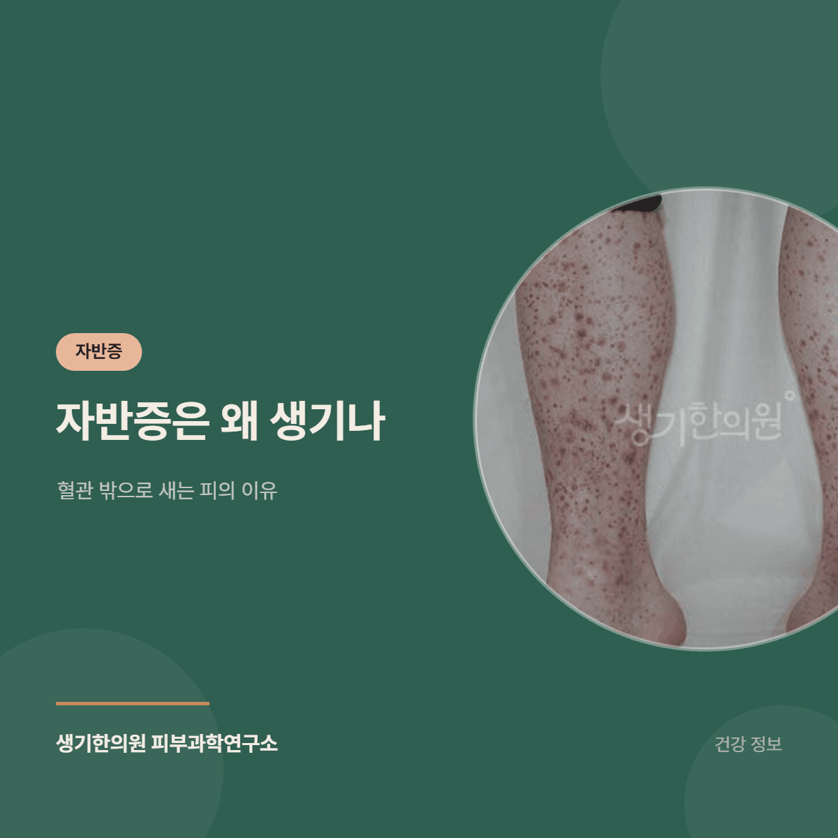 자반증은 왜 생기나 — 혈관 밖으로 새는 피의 이유 대표 이미지