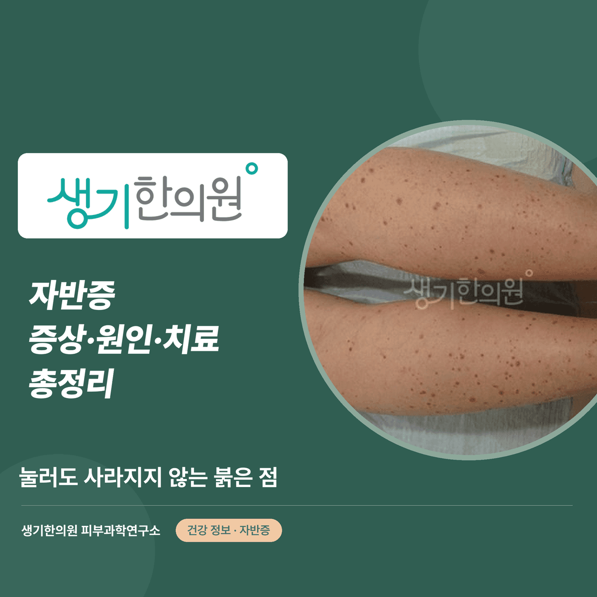 자반증 증상·원인·치료 총정리 대표 이미지