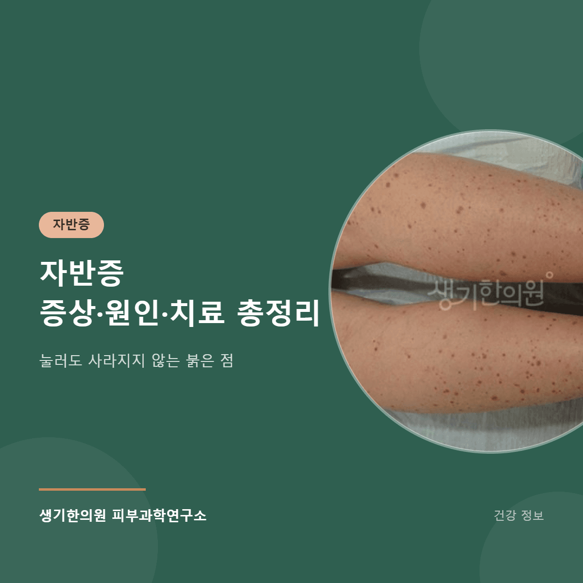 자반증 증상·원인·치료 총정리 대표 이미지