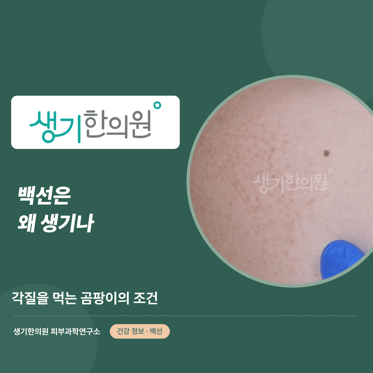 백선은 왜 생기나 — 각질을 먹는 곰팡이의 조건 대표 이미지