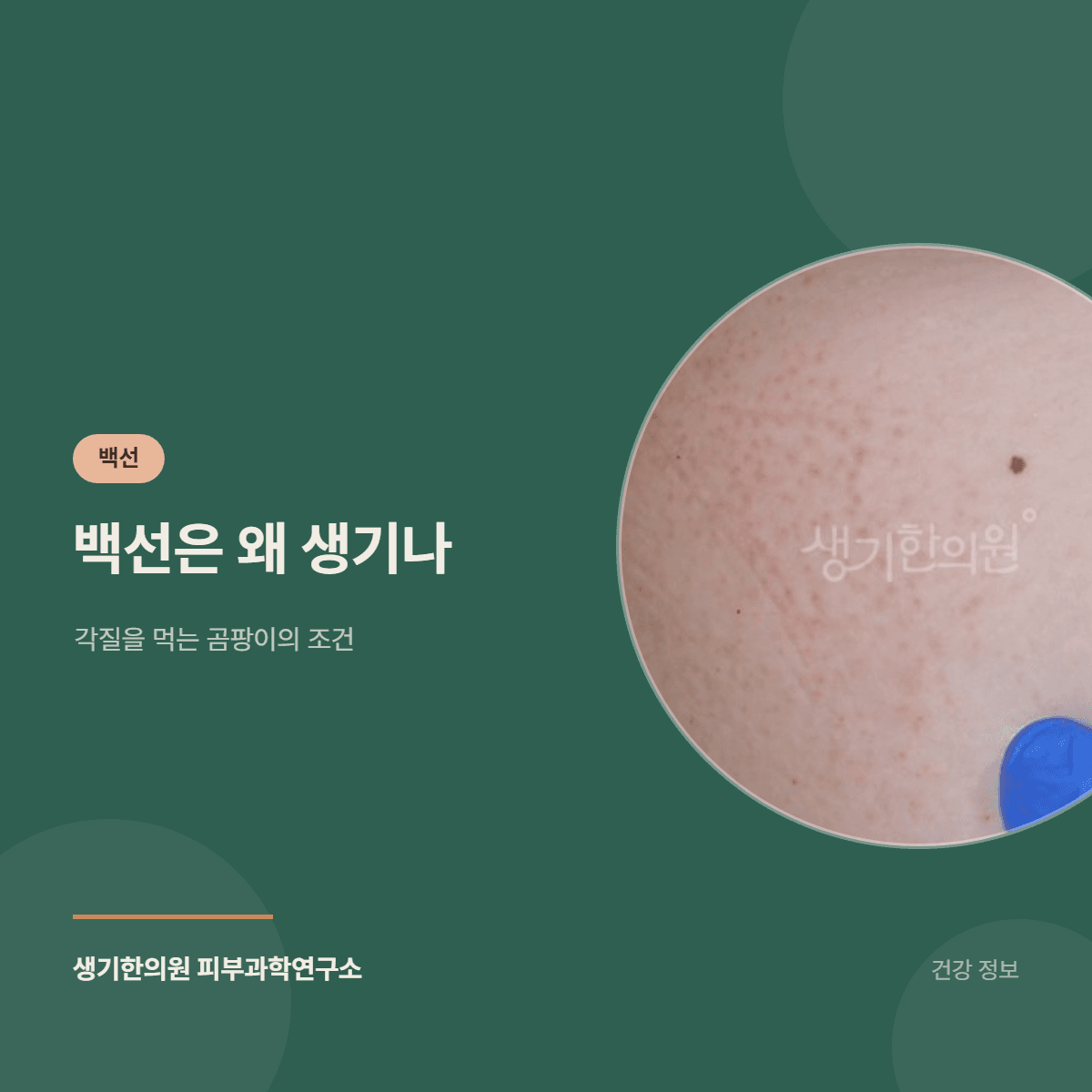 백선은 왜 생기나 — 각질을 먹는 곰팡이의 조건 대표 이미지