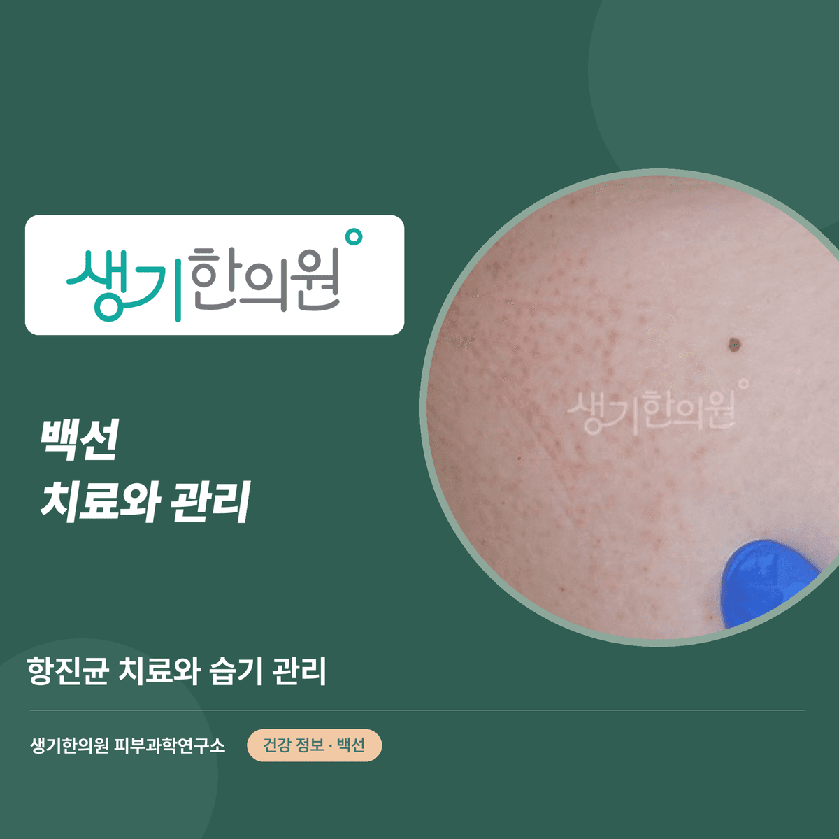 백선 치료와 관리 — 항진균 치료와 습기 관리 대표 이미지