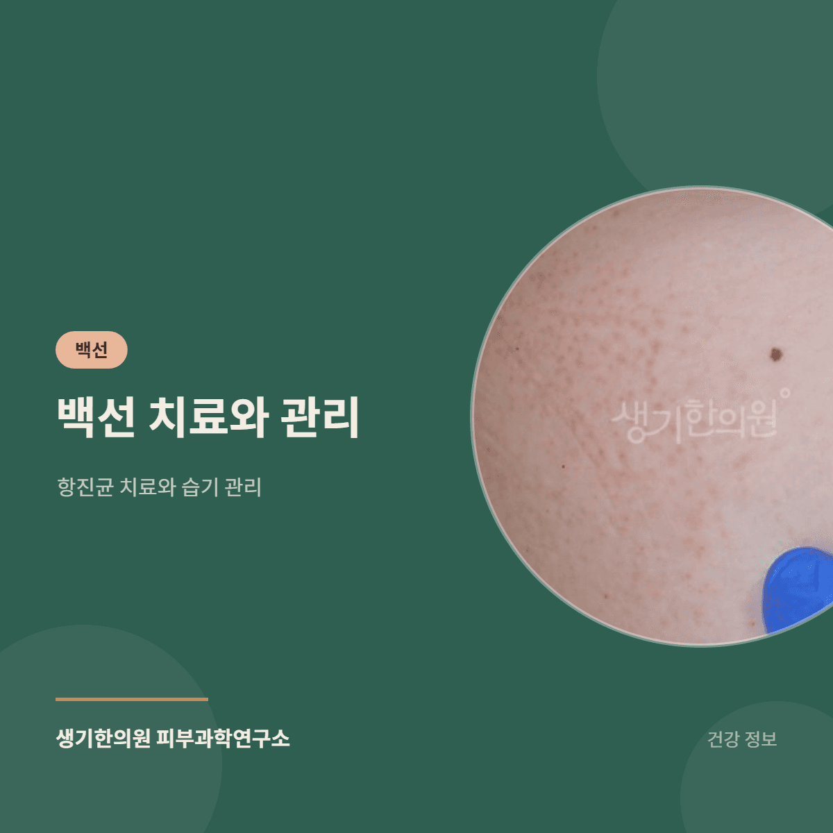백선 치료와 관리 — 항진균 치료와 습기 관리 대표 이미지