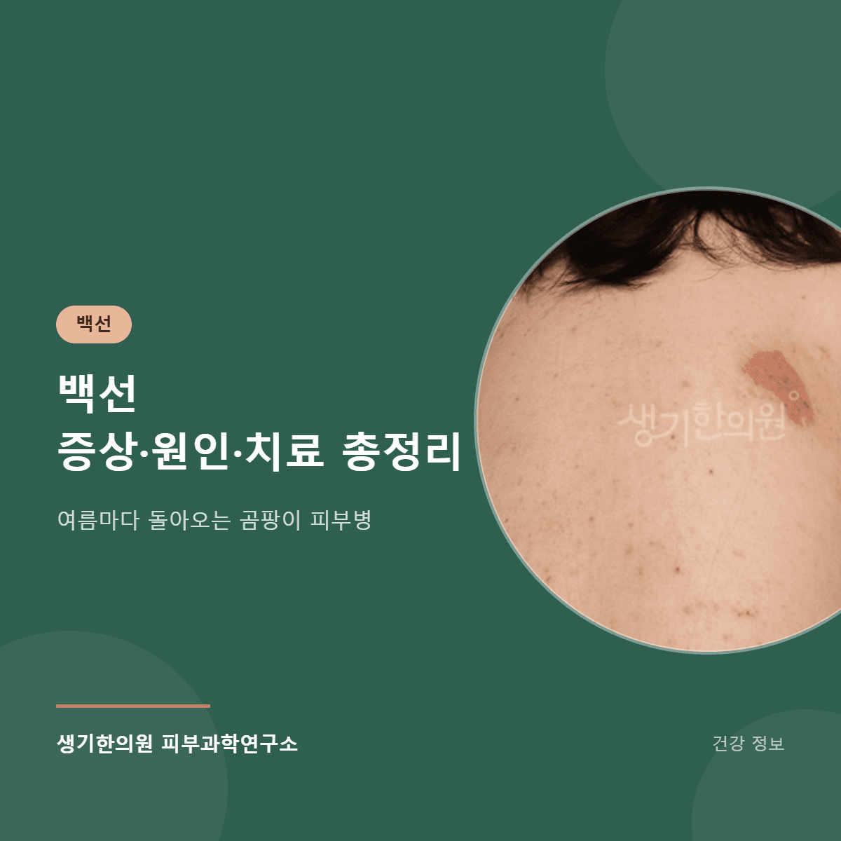 백선 증상·원인·치료 총정리 대표 이미지