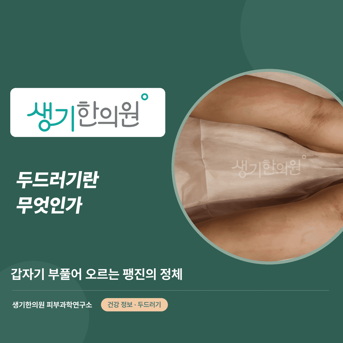 두드러기란 무엇인가 — 갑자기 부풀어 오르는 팽진의 정체 대표 이미지