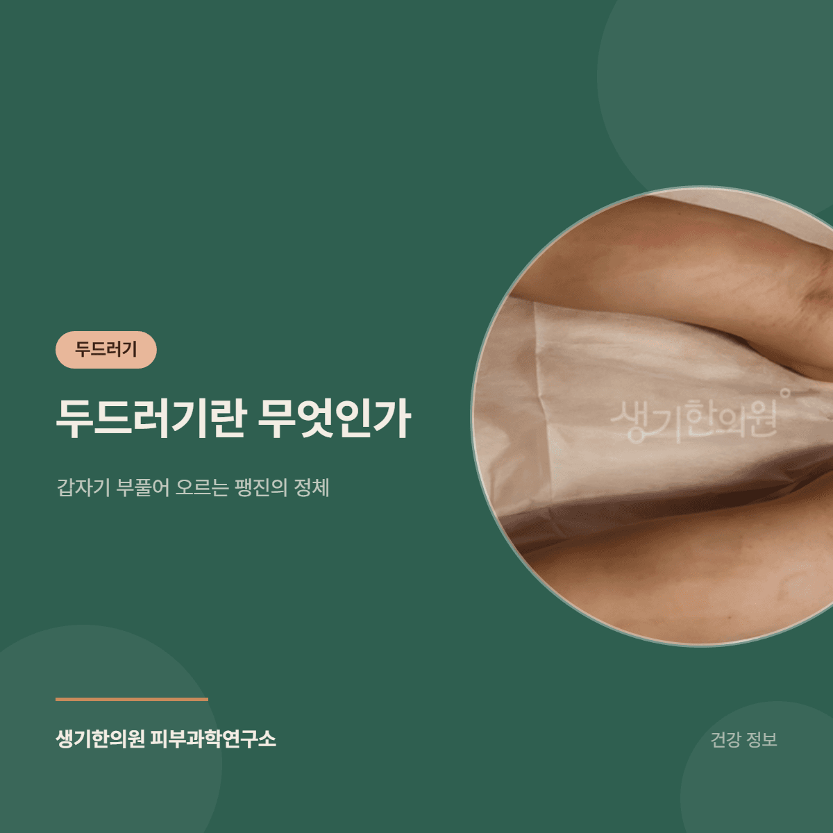 두드러기란 무엇인가 — 갑자기 부풀어 오르는 팽진의 정체 대표 이미지