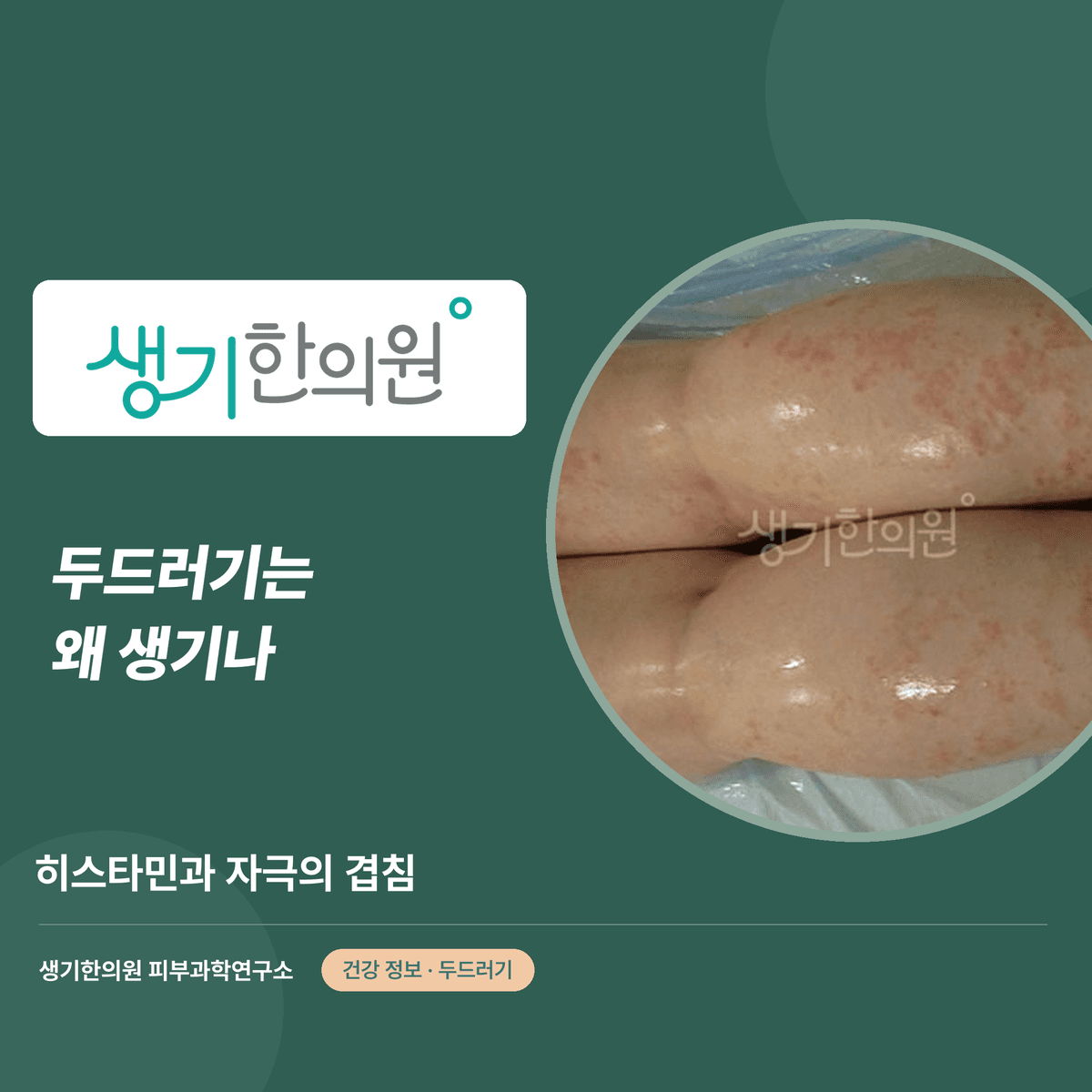 두드러기는 왜 생기나 — 히스타민과 자극의 겹침 대표 이미지