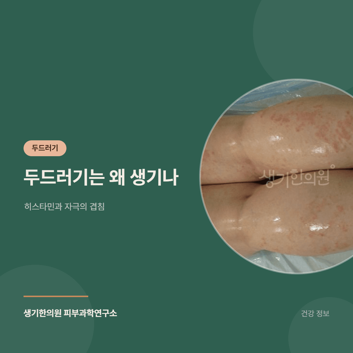 두드러기는 왜 생기나 — 히스타민과 자극의 겹침 대표 이미지