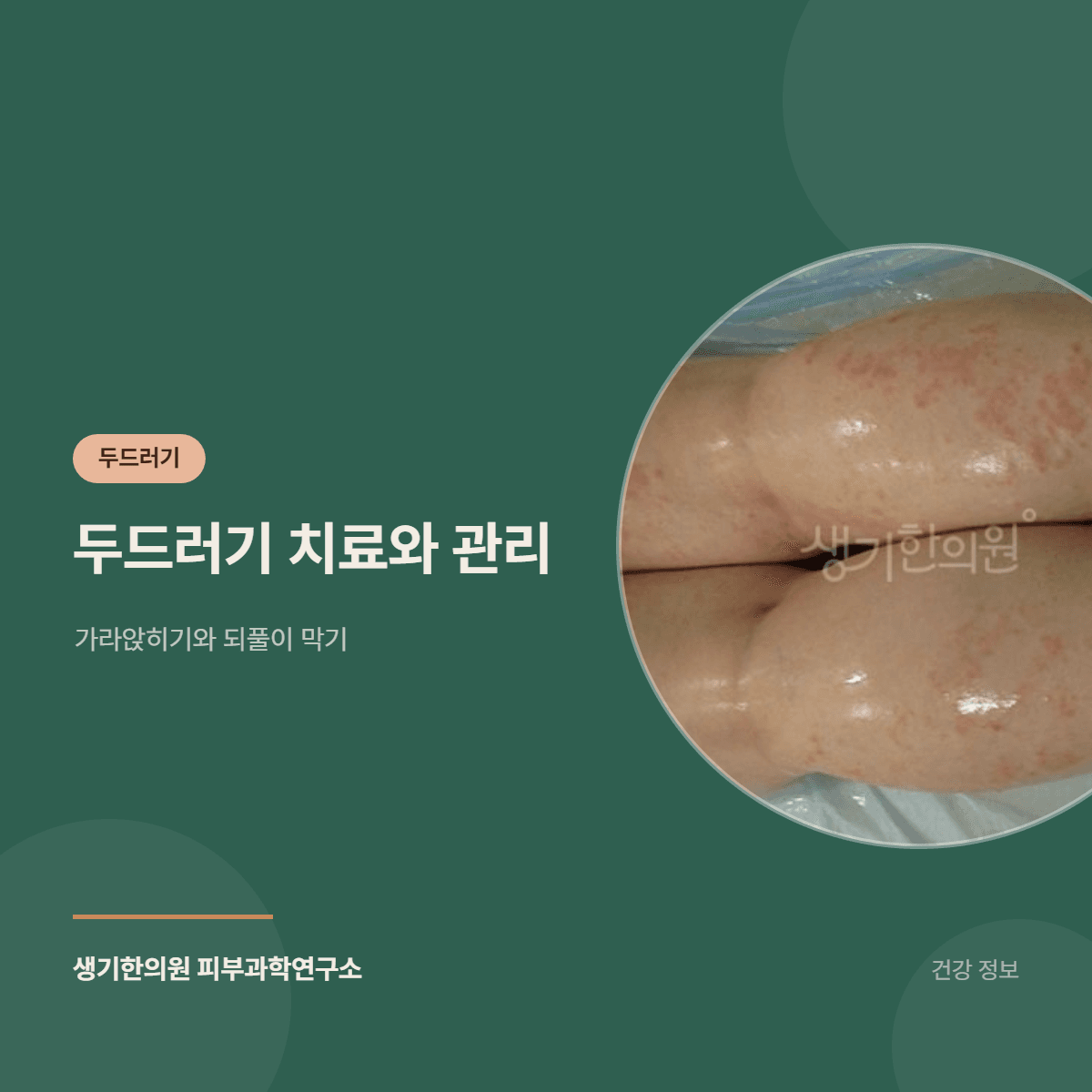 두드러기 치료와 관리 — 가라앉히기와 되풀이 막기 대표 이미지