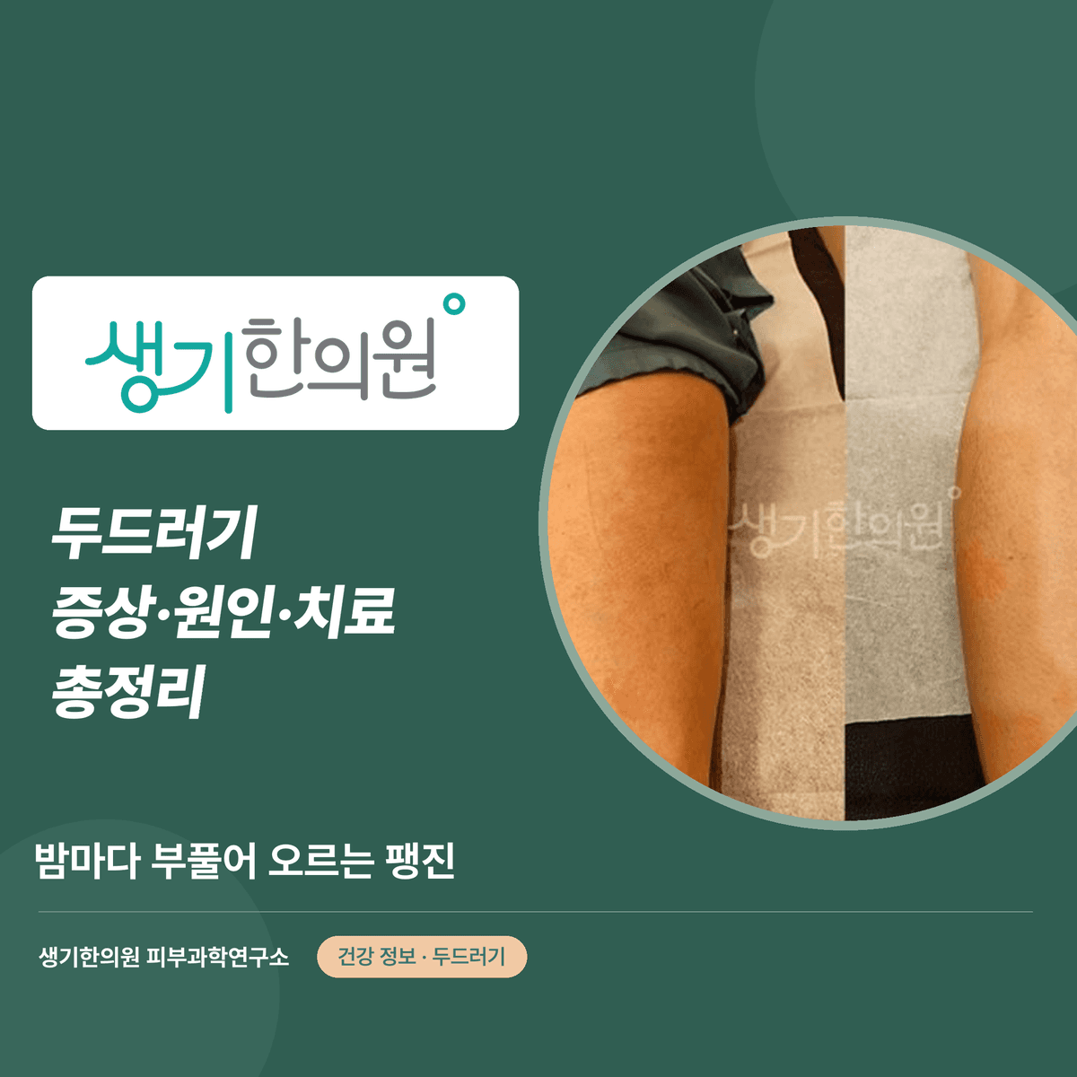 두드러기 증상·원인·치료 총정리 대표 이미지
