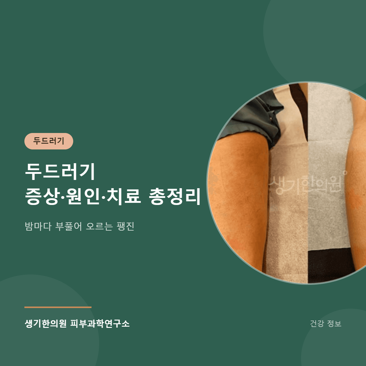 두드러기 증상·원인·치료 총정리 대표 이미지