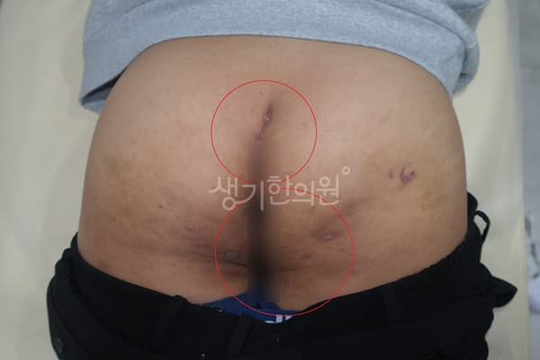 화농성한선염 치료 전 사진 — 천안아산점, 치료 기간 3개월