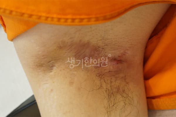 화농성한선염 치료 전 사진 — 대구점, 치료 기간 2개월