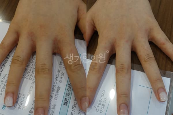 한포진 치료 전 사진 — 부천점, 치료 기간 10개월