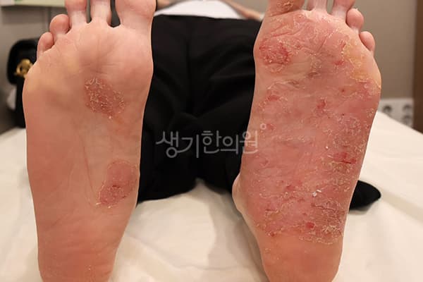 한포진 치료 전 사진 — 분당점, 치료 기간 4개월