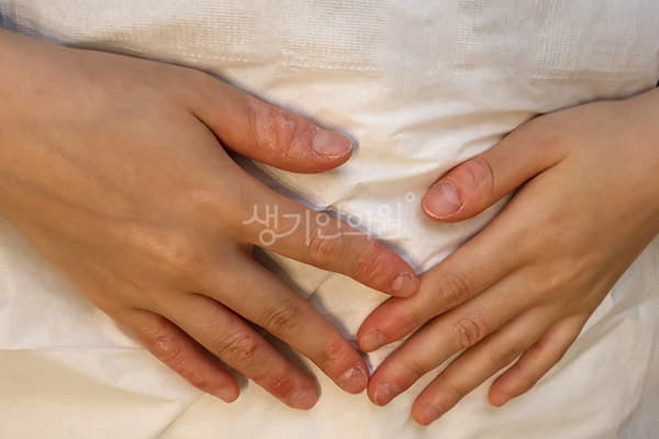 한포진 치료 전 사진 — 분당점, 치료 기간 3개월