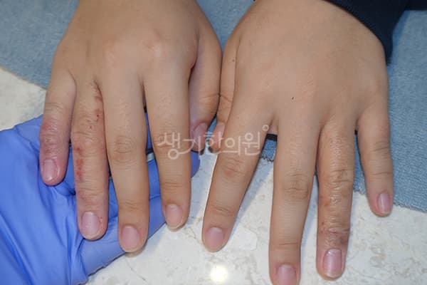 한포진 치료 전 사진 — 천안아산점, 치료 기간 4개월